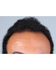 Before Hair Transplant  Front